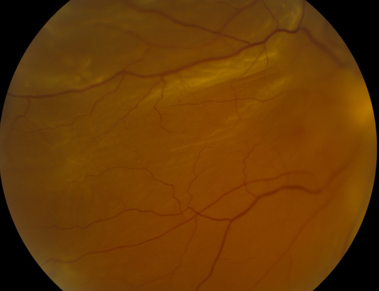 Clinical eye photograph illustrating Intravitreal Methotrexate Proliferative Vitreoretinopathy