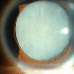 Clinical eye photograph illustrating Intumescent Cataract