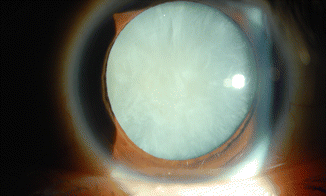 Intumescent Cataract: When a Swelling Lens Becomes a Surgical Emergency