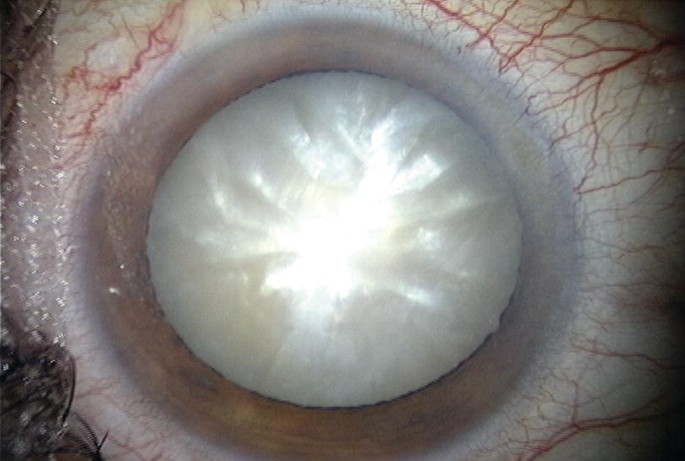 Clinical eye photograph illustrating Intumescent Cataract