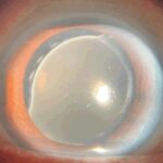 Clinical eye photograph illustrating Iol Calcification Hydrophilic Acrylic