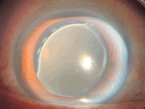 Intraocular Lens Calcification: When a Hydrophilic Acrylic Lens Turns Cloudy Years After Surgery