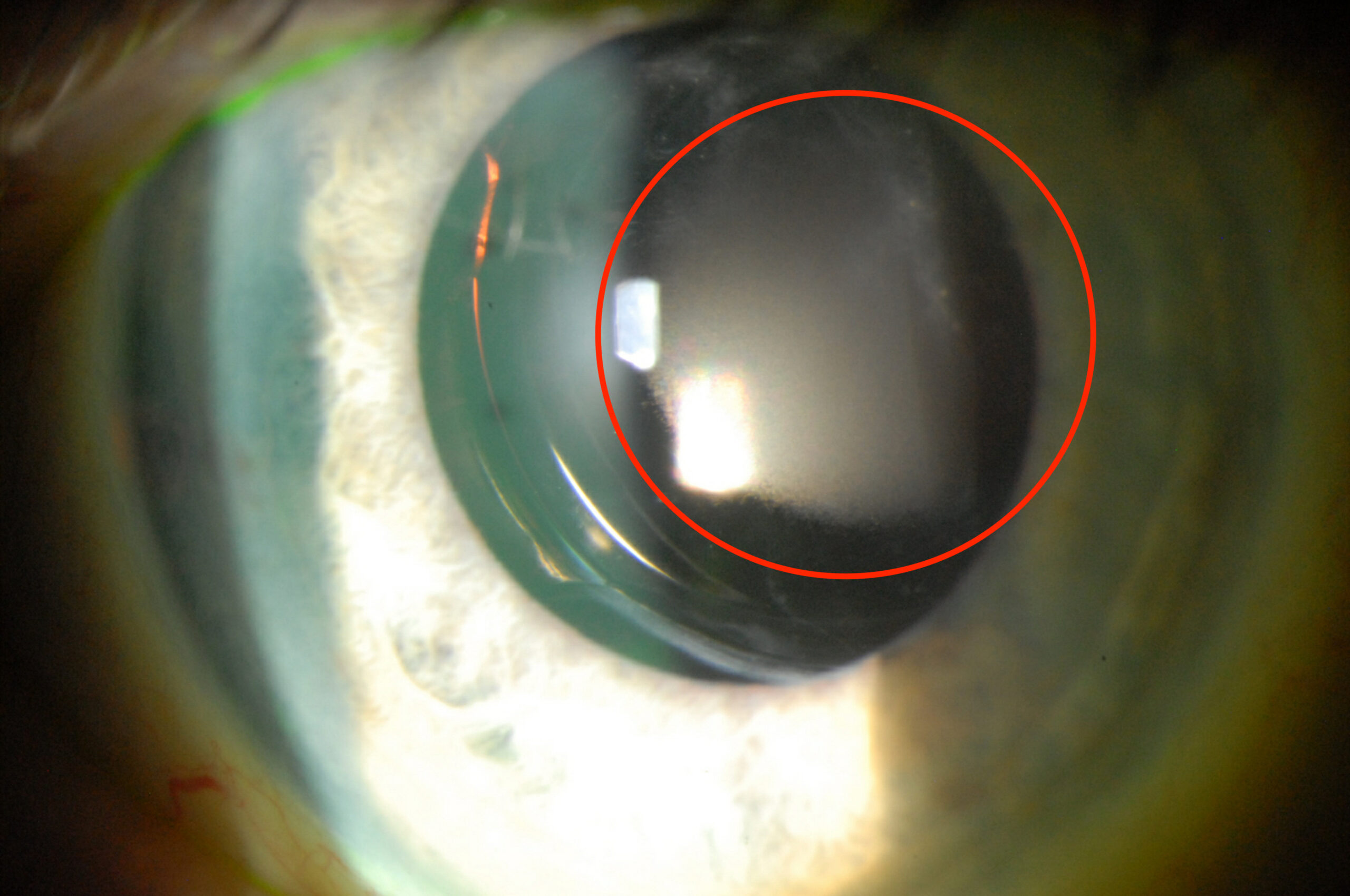 Clinical eye photograph illustrating Iol Calcification Hydrophilic Acrylic