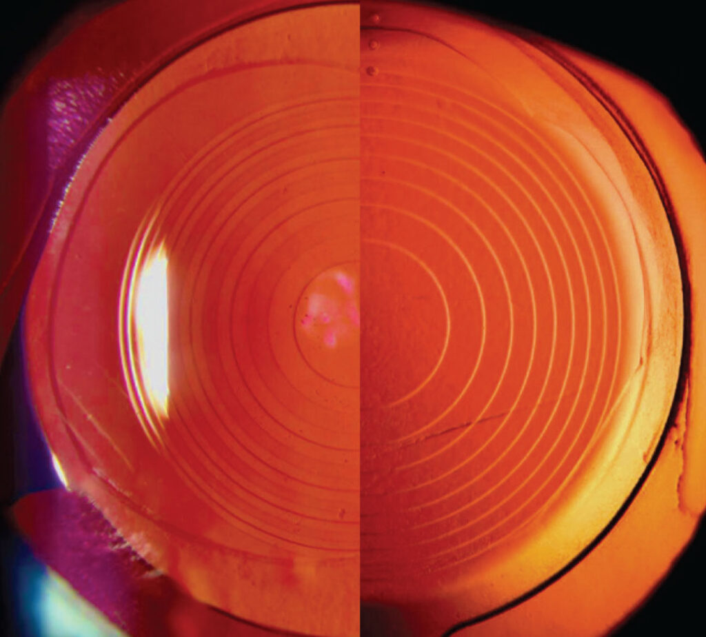Clinical eye photograph illustrating Iol Exchange Explantation
