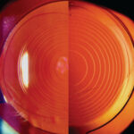 Clinical eye photograph illustrating Iol Exchange Explantation