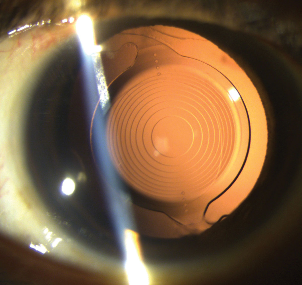 Clinical eye photograph illustrating Iol Exchange Explantation