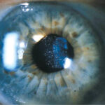 Clinical eye photograph illustrating Iol Glistenings