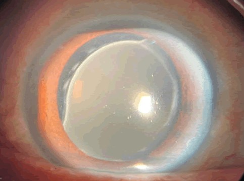 Clinical eye photograph illustrating Iol Glistenings