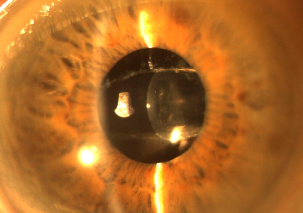 Clinical image illustrating IOL Selection (figure 1)