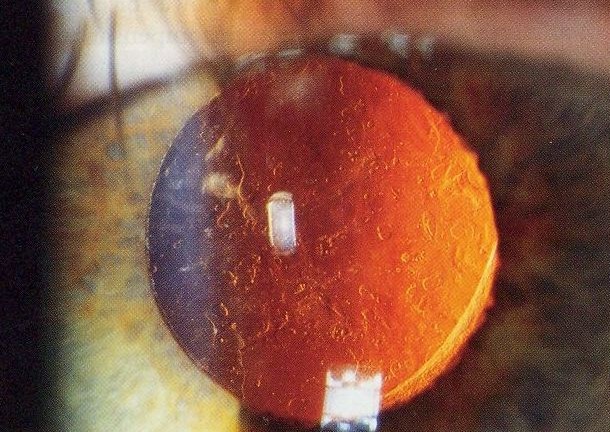 Clinical image illustrating IOL Selection (figure 2)