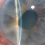 Clinical eye photograph illustrating Iridocorneal Endothelial Syndrome Overview
