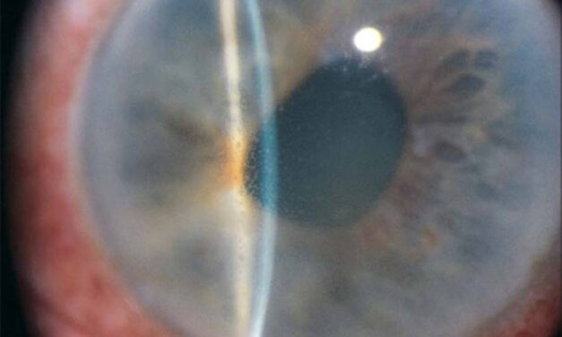 Iridocorneal Endothelial (ICE) Syndrome: The Umbrella Over Chandler, Cogan-Reese, and Essential Iris Atrophy
