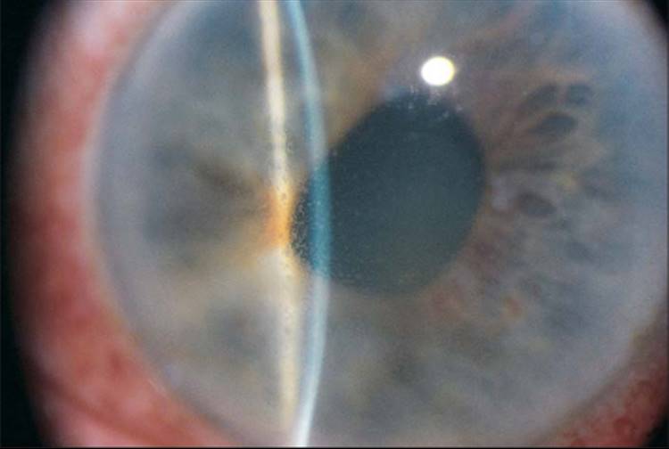 Clinical eye photograph illustrating Iridocorneal Endothelial Syndrome Overview