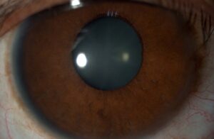 Clinical image illustrating Iridodonesis (Shaking Iris)