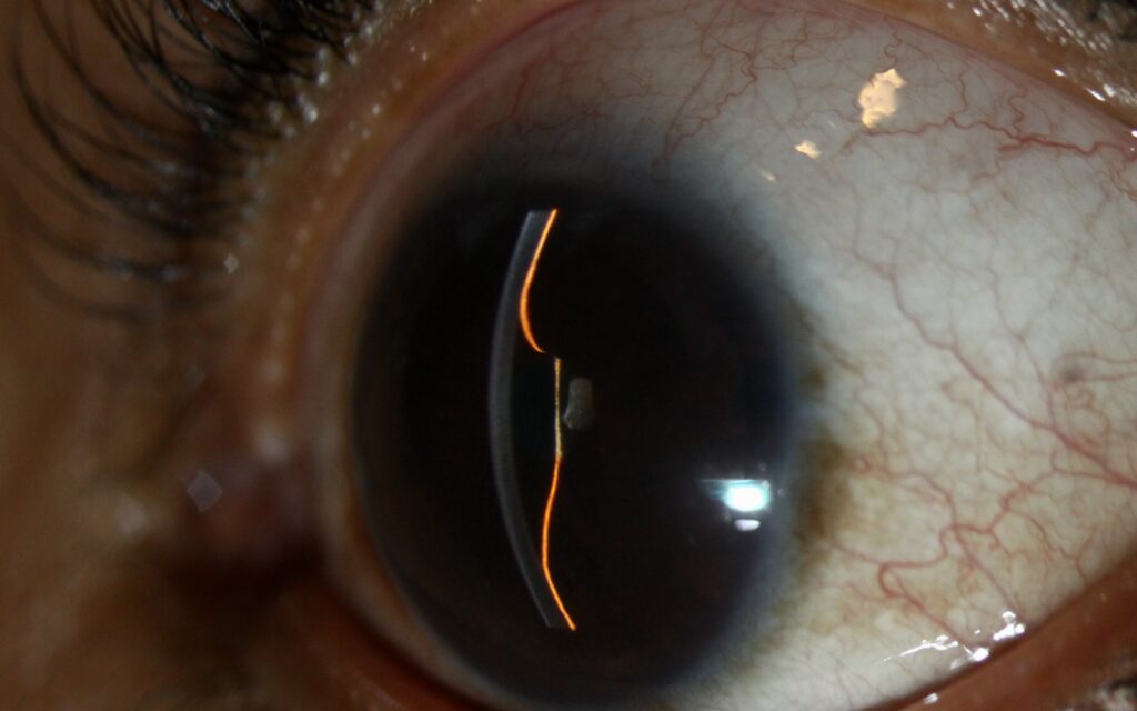 Clinical eye photograph illustrating Iris Bombe Pupillary Block