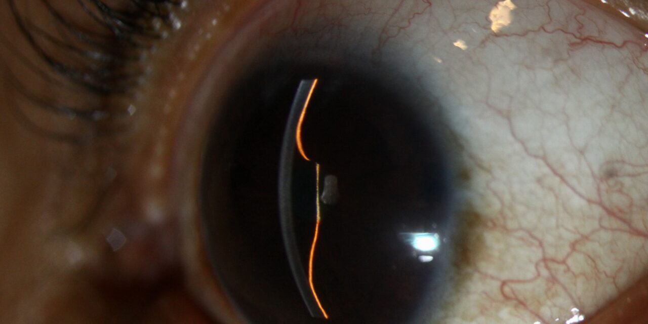 Iris Bombe: What a Bulging, Forward-Convex Iris Is Telling You About Pupillary Block