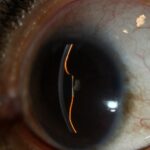 Clinical eye photograph illustrating Iris Bombe Pupillary Block