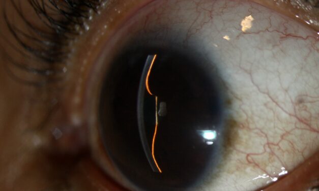 Iris Bombe: What a Bulging, Forward-Convex Iris Is Telling You About Pupillary Block