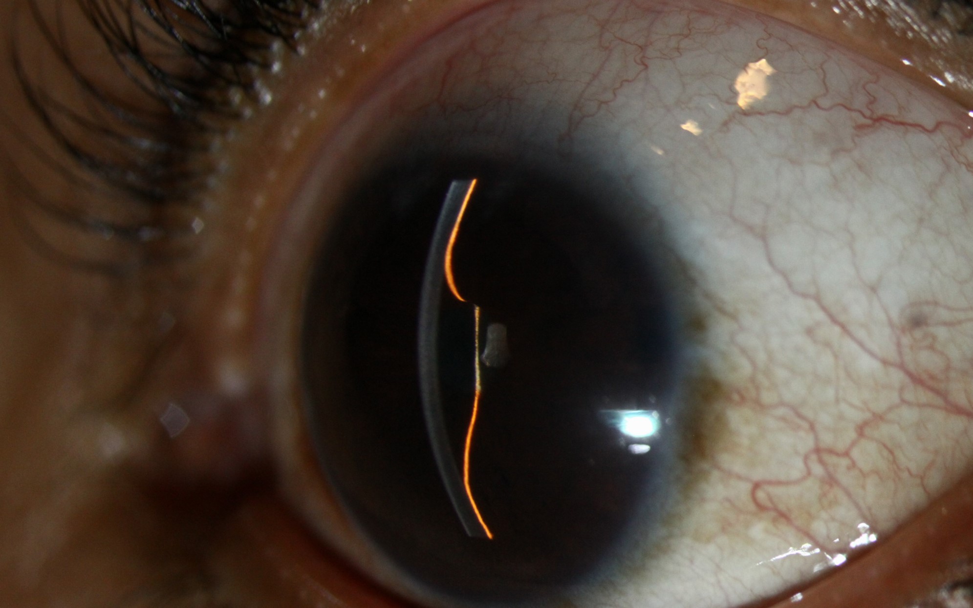 Clinical eye photograph illustrating Iris Bombe Pupillary Block