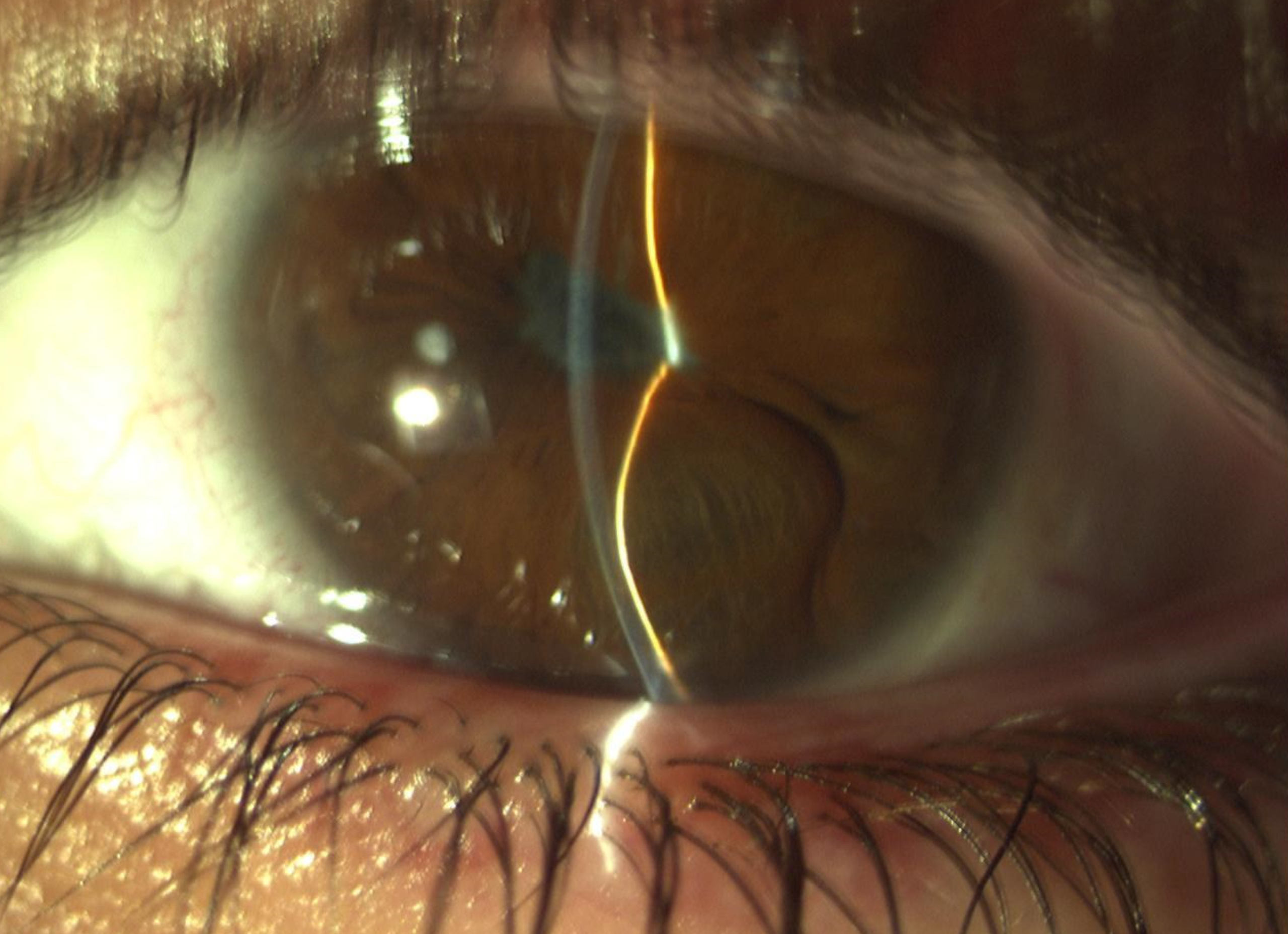 Clinical eye photograph illustrating Iris Bombe Pupillary Block