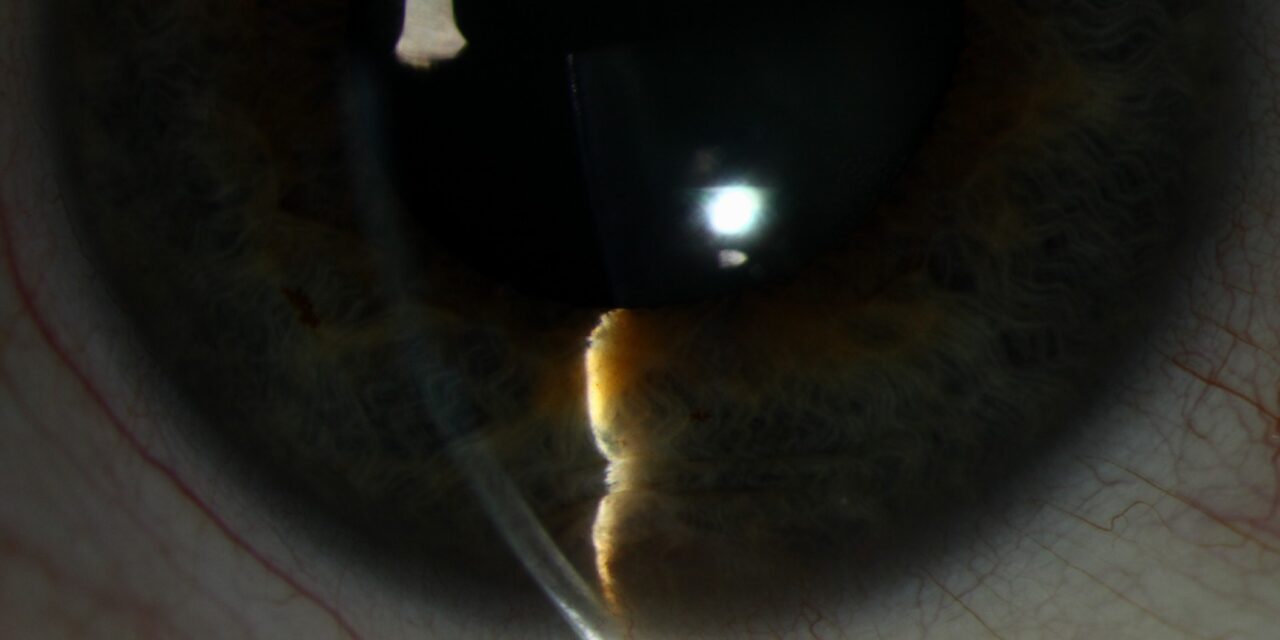 Iris Cysts: When a Pigmented Bulge Turns Out to Be Fluid, Not Solid