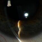 Clinical eye photograph illustrating Iris Cyst Classification
