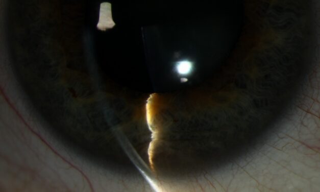 Iris Cysts: When a Pigmented Bulge Turns Out to Be Fluid, Not Solid