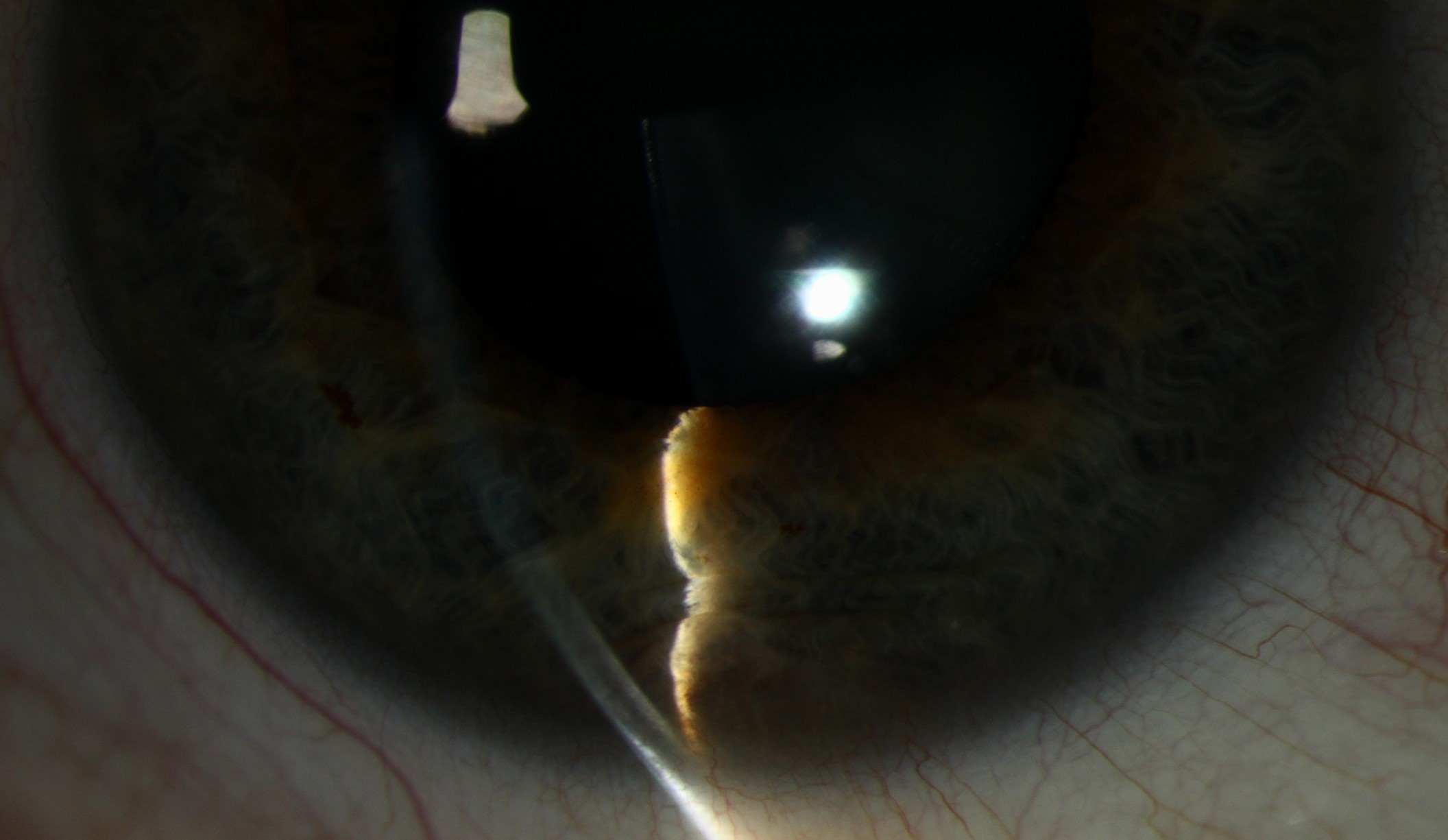 Clinical eye photograph illustrating Iris Cyst Classification