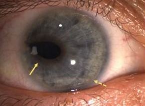 Clinical eye photograph illustrating Iris Cyst Classification