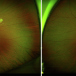 Clinical eye photograph illustrating Iris Mammillations Clinical Significance