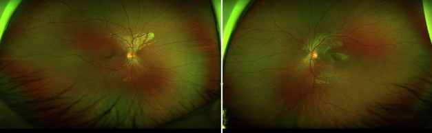 Iris Mammillations: The Velvety Iris Surface Worth a Second Look