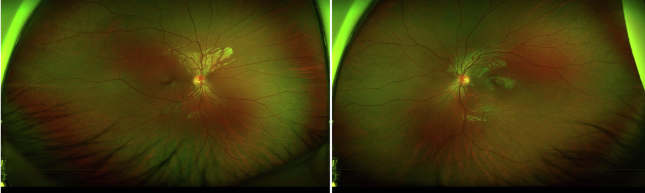 Iris Mammillations: The Velvety Iris Surface Worth a Second Look