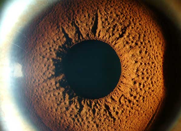 Clinical eye photograph illustrating Iris Mammillations Clinical Significance