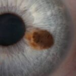 Clinical eye photograph illustrating Iris Nevus vs Melanoma Differentiation