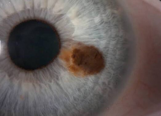 Iris Nevus Versus Melanoma: The Slit-Lamp Features That Separate Benign From Malignant