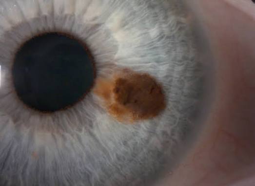 Iris Nevus Versus Melanoma: The Slit-Lamp Features That Separate Benign From Malignant