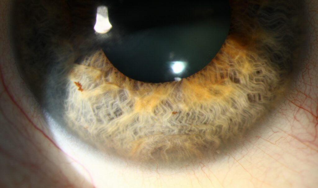 Clinical eye photograph illustrating Iris Pigment Epithelial Cyst Management