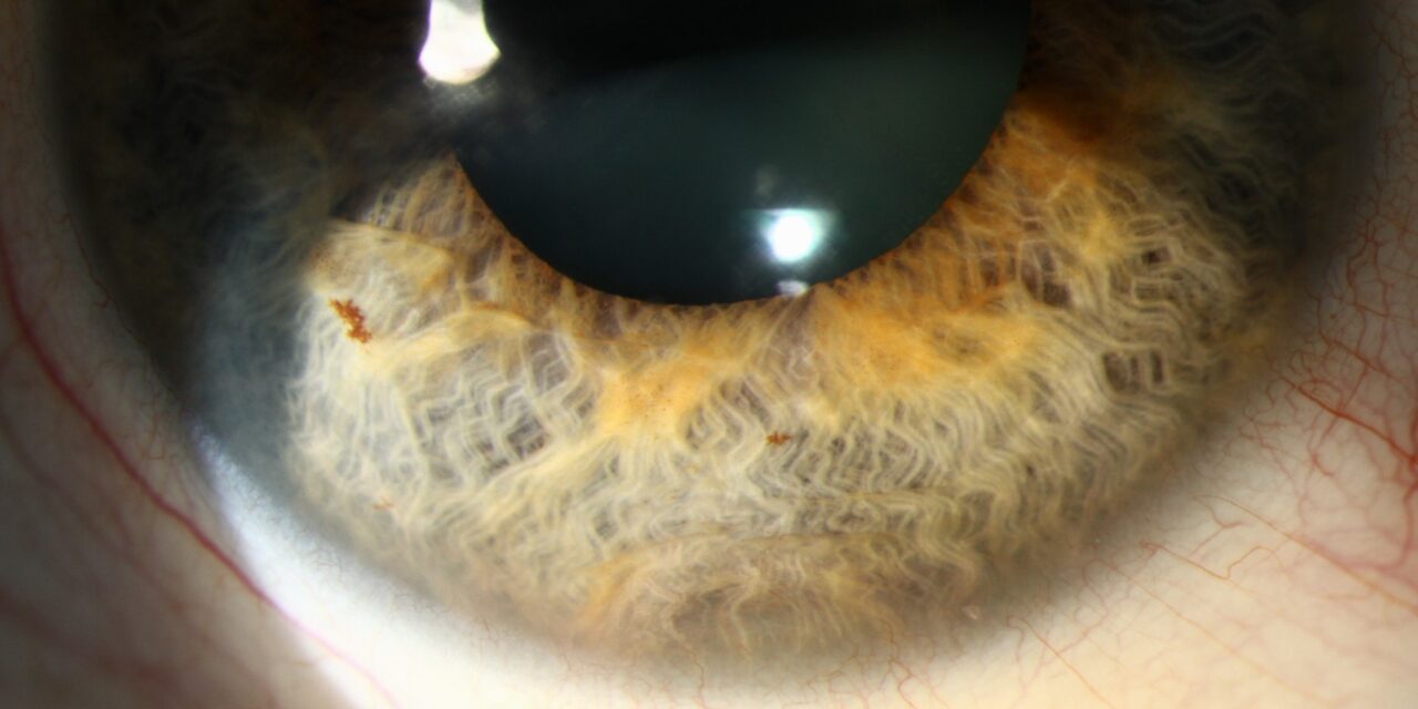 Iris Pigment Epithelial Cysts: The Most Common Type, and Usually the Least Worrying
