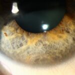 Clinical eye photograph illustrating Iris Pigment Epithelial Cyst Management