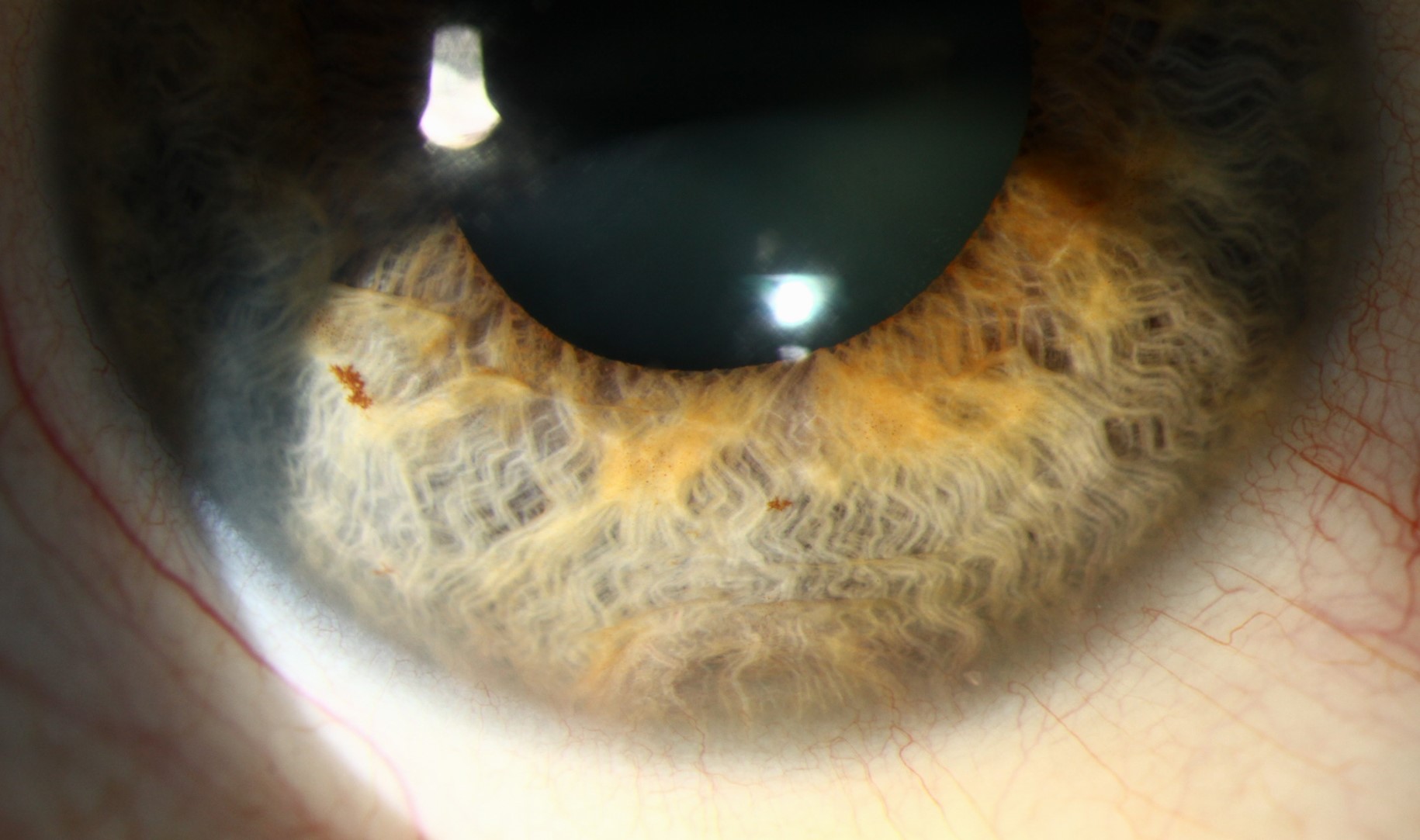 Clinical eye photograph illustrating Iris Pigment Epithelial Cyst Management