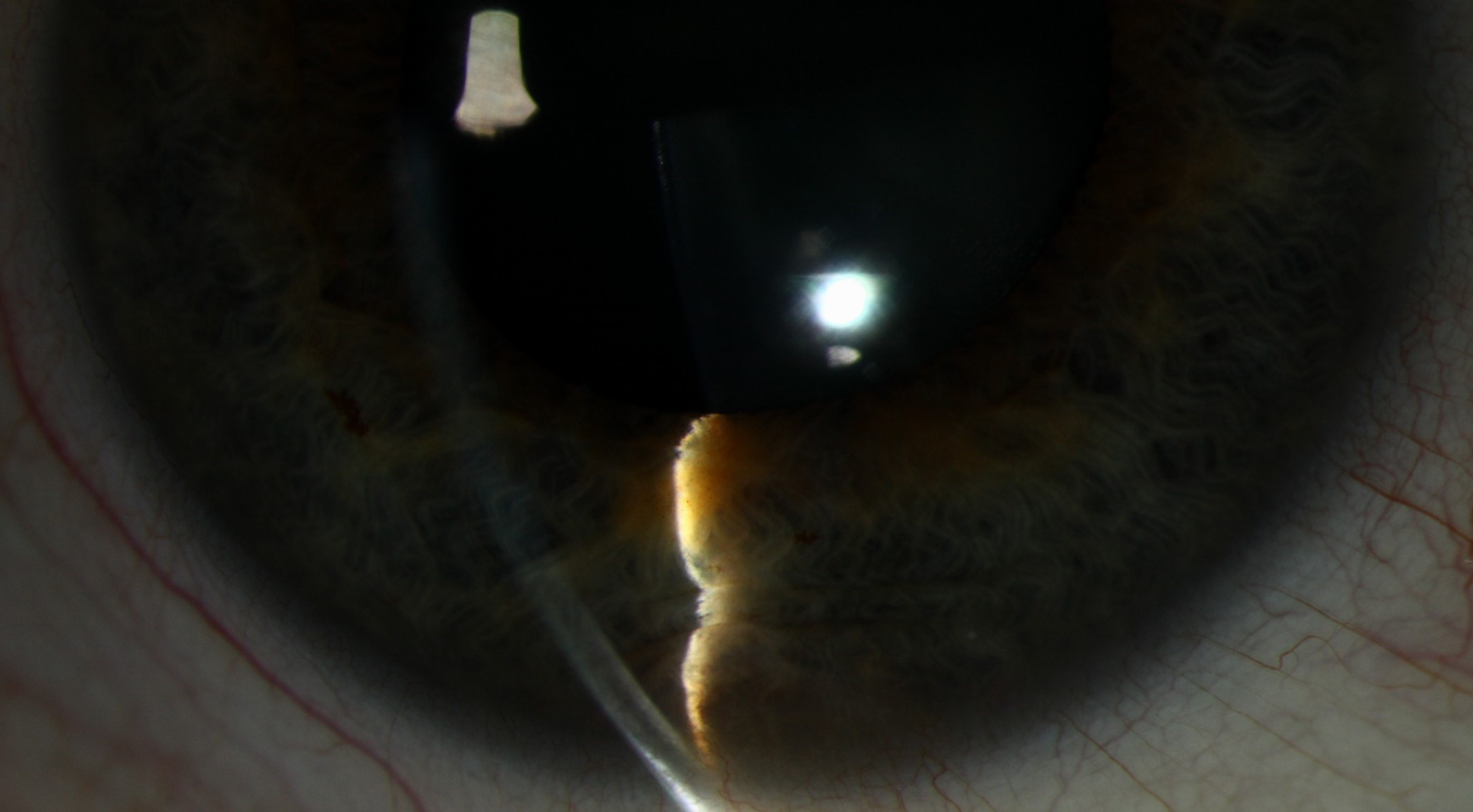 Clinical eye photograph illustrating Iris Pigment Epithelial Cyst Management
