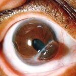 Clinical eye photograph illustrating Iris Prolapse Causes Management