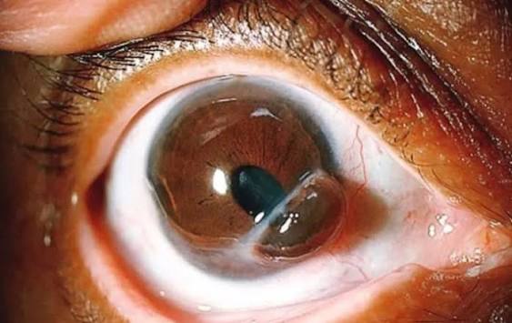 Iris Prolapse: Causes, Recognition and Repair of Iris Through a Wound