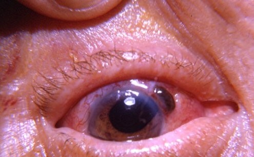 Clinical eye photograph illustrating Iris Prolapse Causes Management