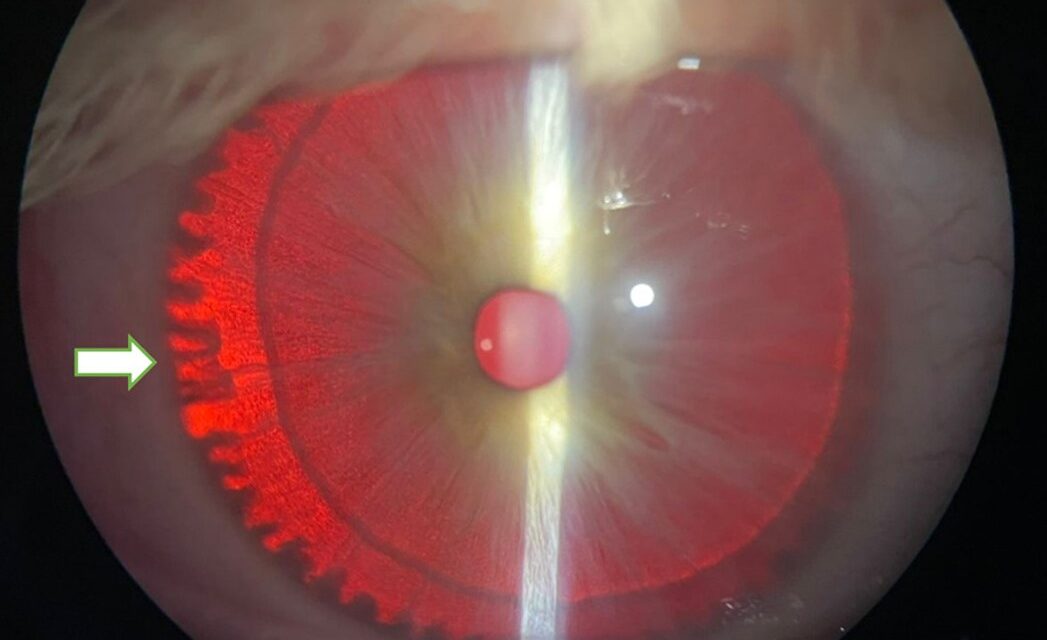 Iris Transillumination Defects: Letting Light Reveal What’s Missing