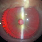 Clinical eye photograph illustrating Iris Transillumination Defects Causes