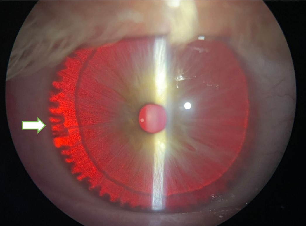Clinical eye photograph illustrating Iris Transillumination Defects Causes