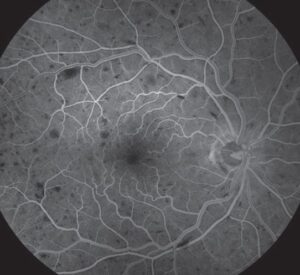 Clinical eye photograph illustrating Ischemic Crvo Signs Neovascular Glaucoma Management