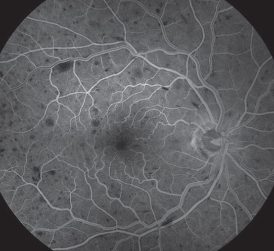 Clinical eye photograph illustrating Ischemic Crvo Signs Neovascular Glaucoma Management