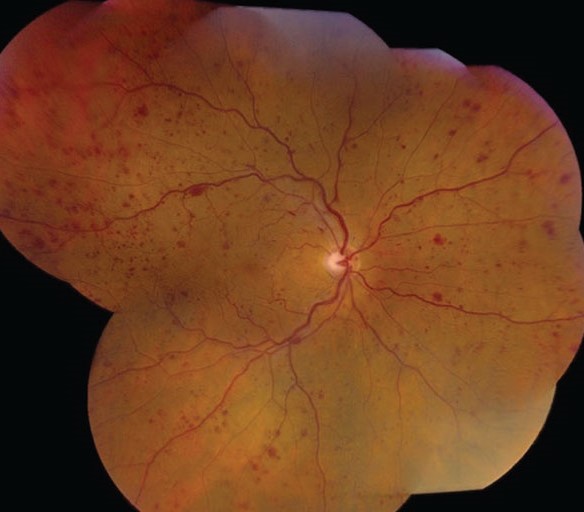 Clinical eye photograph illustrating Ischemic Crvo Signs Neovascular Glaucoma Management